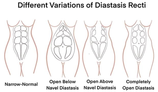 Different variation of diastasis recti